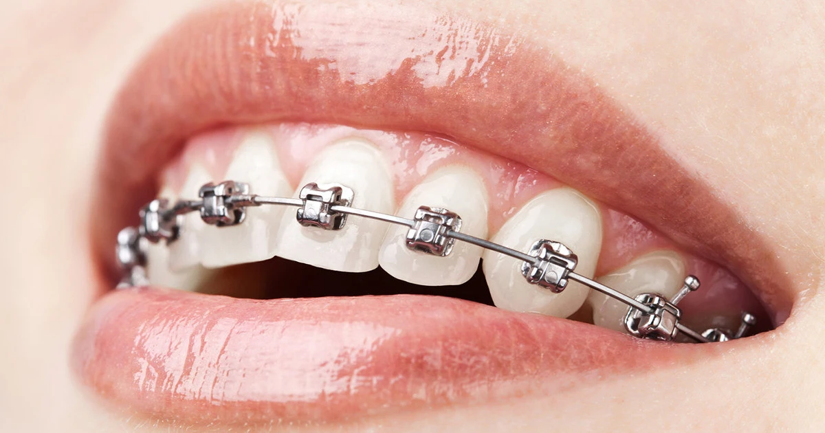 Aparat dentar autoligaturant