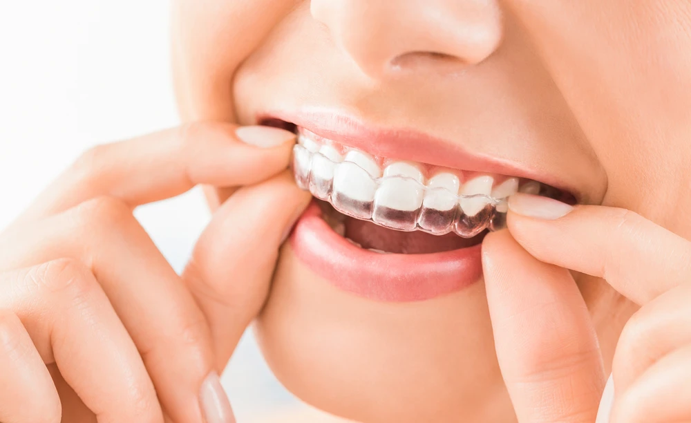 Aparat dentar invizibil — alignere transparente