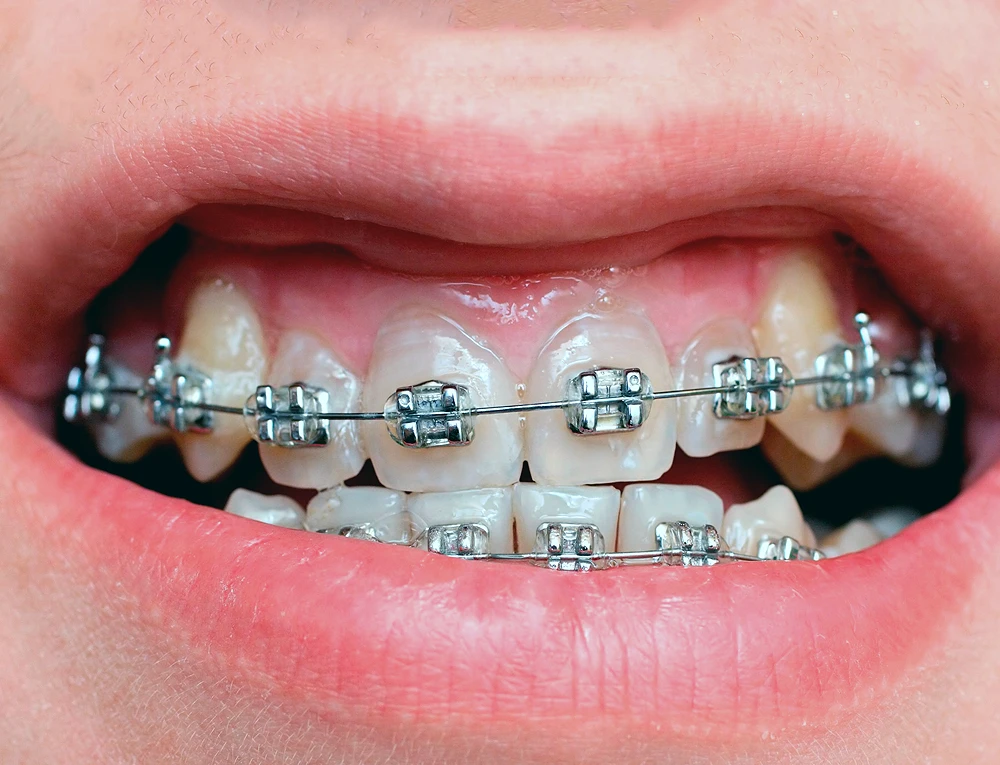 Aparat dentar metalic