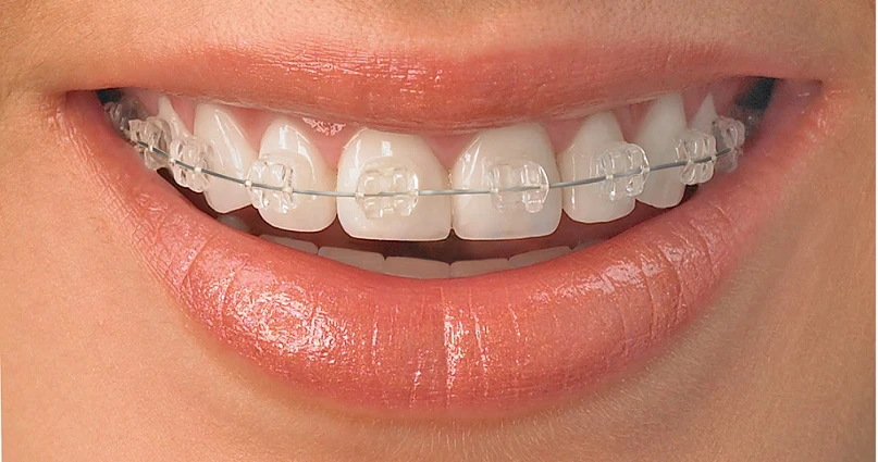 Aparat dentar ceramic și din safir